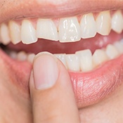 A chipped or broken tooth can be fixed with timely emergency dentistry.