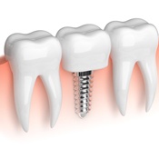 Close up photo of a dental implant, showing the tooth implant process.