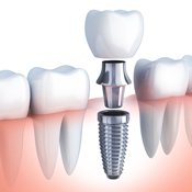 Close up photo of a tooth implant.