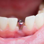 A dental implant is a great tooth replacement option for Tulsa patients.
